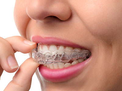 The image shows a person with a smile holding an Invisalign aligner tray near their mouth.