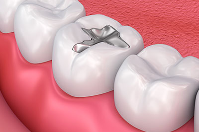 Mountain View Dentistry | Root Canals, Oral Exams and Dentures