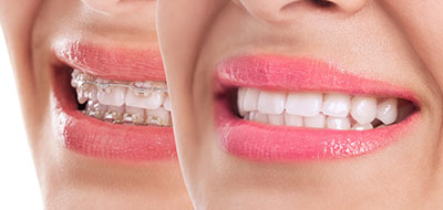 Mountain View Dentistry | Oral Exams, Preventative Program and Extractions