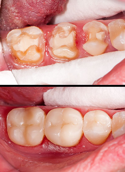 Mountain View Dentistry | Implant Dentistry, Invisalign reg  and Pediatric Dentistry