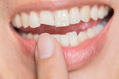 Mountain View Dentistry | Teeth Whitening, Inlays  amp  Onlays and Oral Cancer Screening
