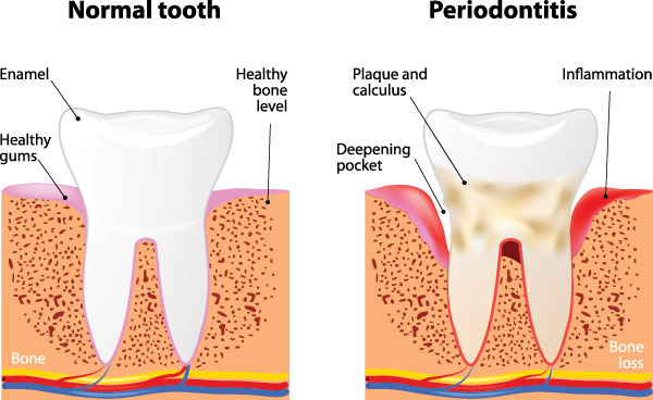 Mountain View Dentistry | Night Guards, Fluoride Treatment and Periodontal Treatment