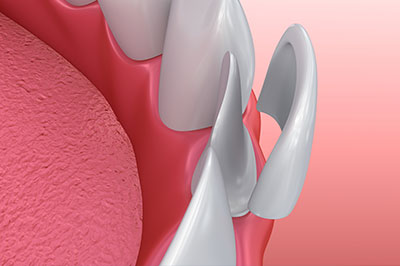 Mountain View Dentistry | Veneers, Root Canals and Sports Mouthguards