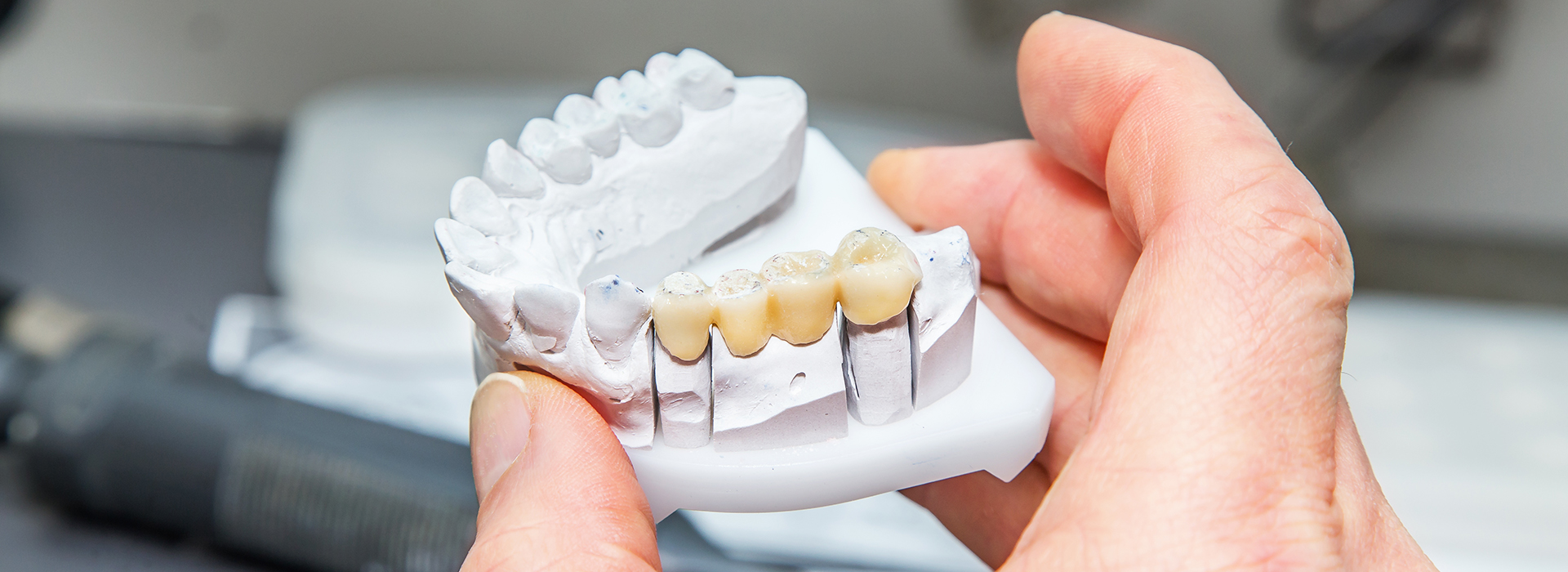 A person holding a set of dentures with missing teeth, showcasing the dental model for repair or replacement.