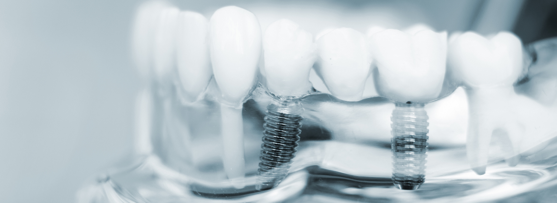 This is a close-up photograph of multiple toothbrushes with bristles, placed on a surface with a blurred background, showcasing their design and color variations.