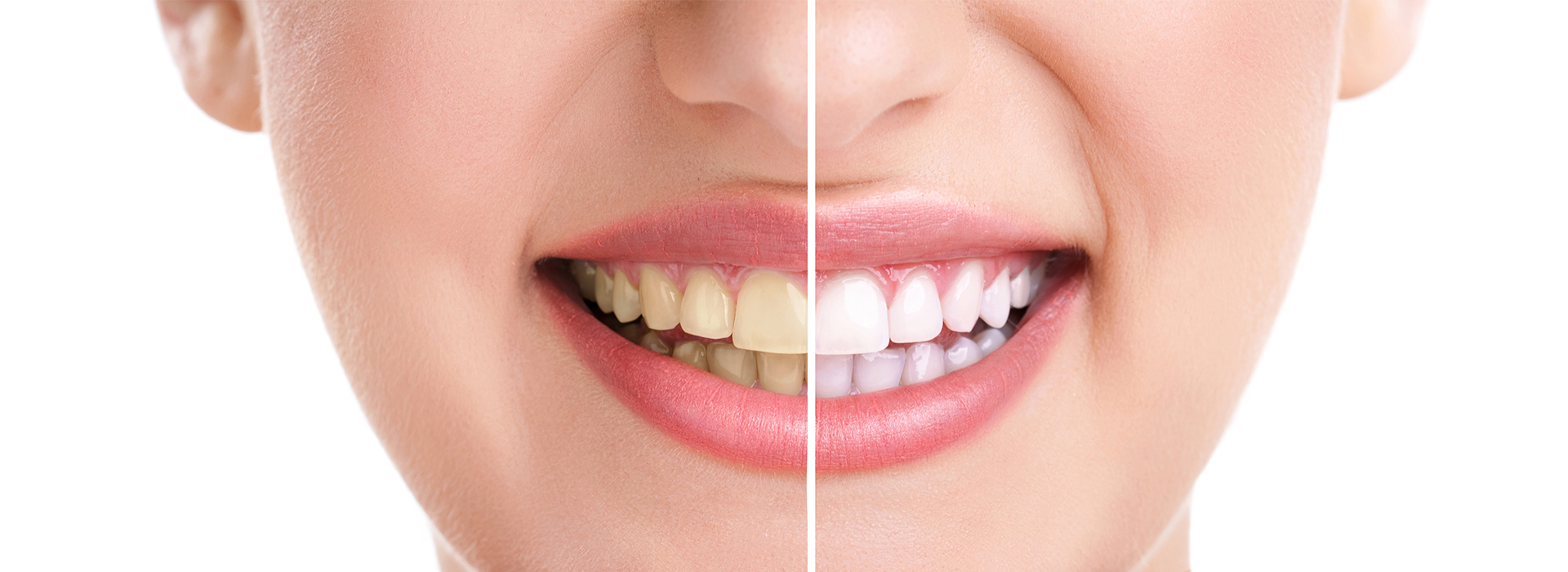 The image shows a close-up of a person s face with a focus on their teeth and mouth, which are brightly lit against a darker background.
