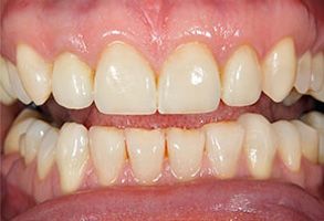 The image shows a close-up of a person s teeth with a focus on yellowing and staining, which are indicative of poor oral hygiene or dental issues.