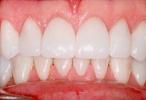 The image displays a close-up view of a person s teeth with a focus on dental implants, showcasing the bright white color and the natural appearance of the artificial tooth roots.