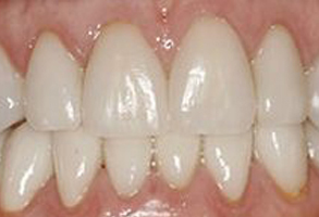 The image shows a close-up of a person s teeth with an unhealthy appearance, possibly indicating dental issues such as decay or staining.