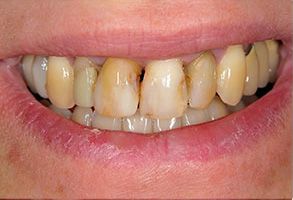 The image displays a person s mouth with yellowed teeth and gums, suggesting poor oral hygiene or dental health issues.