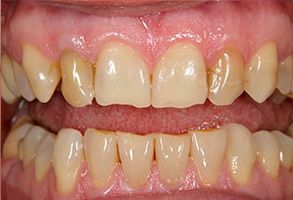 The image displays two photos of teeth with visible signs of decay and discoloration, emphasizing dental health concerns.