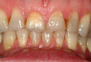 The image displays two close-up photographs of a person s teeth with significant discoloration and decay  the upper photo shows a partial view of the teeth, while the lower photo provides a fuller perspective, emphasizing the severity of the dental issues.